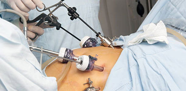 laparoscopy surgery