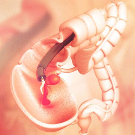 colonoscopy in Vijayawada