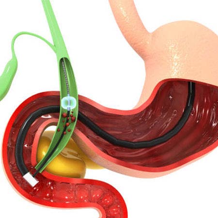 biliary surgery in vijayawada