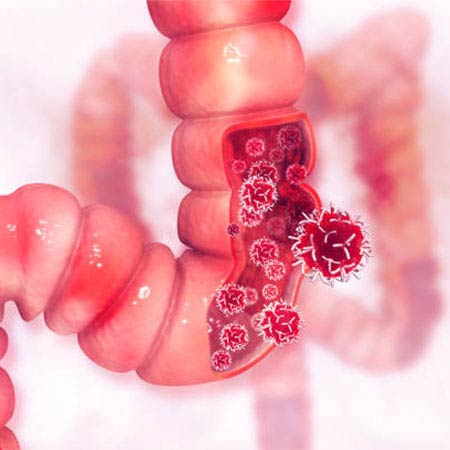 gastrointestinal cancer treatment in Vijayawada