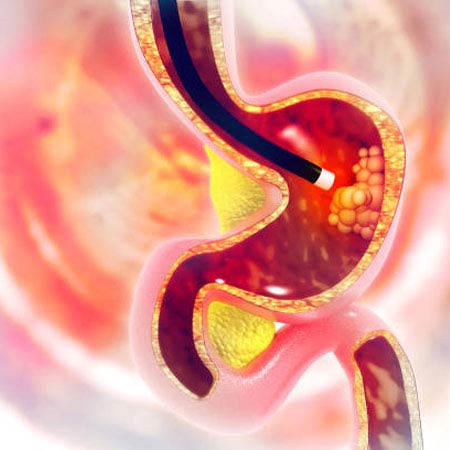 gastroscopy