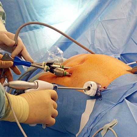 laparoscopic surgery